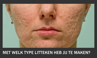 Welke behandeling voor welk litteken?